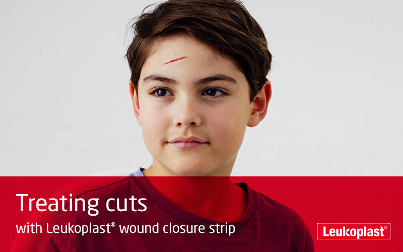 Here is shown how to treat cut wounds with the help of Leukoplast wound closure strip: we see two hands close-up using wound closure strips to close a cut on a boy's forehead. Here is shown how to treat cut wounds with the help of Leukoplast wound closure strip: we see two hands close-up using wound closure strips to close a cut on a boy's forehead.